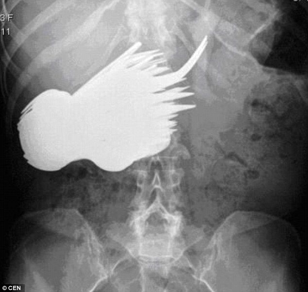 Ketika di X-Ray dalam perut korban ada banyak logam sendok dan garpu