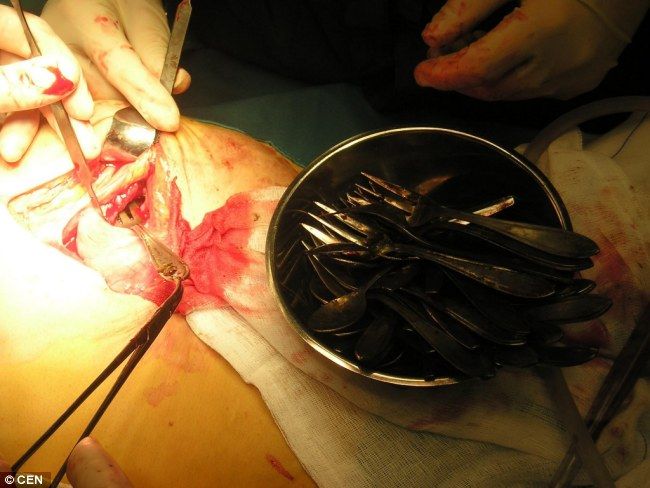Tim dokter di rumah sakit Rotterdam akhirnya mengambil satu per satu sendok dan garpu dalam perut Margaret
