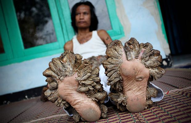 feet 1543841i Kisah Penderitaan Dede Koswara 'Manusia Kutil'
