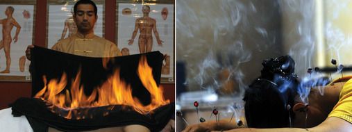 Selain menyalakan api dipunggung terapi di klinik ini juga dengan  menggunakan jarum akupuntur panas yang ditusukan ke tubuh