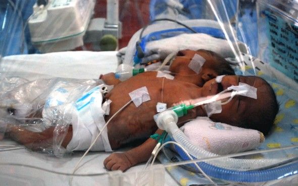 Salah satu kasus bayi berkepala dua di Indonesia Salah satu kasus bayi berkepala dua di Indonesia